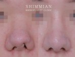 Contracted nose correction