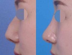 The nose has changed to hawker nose caused by inflammation.